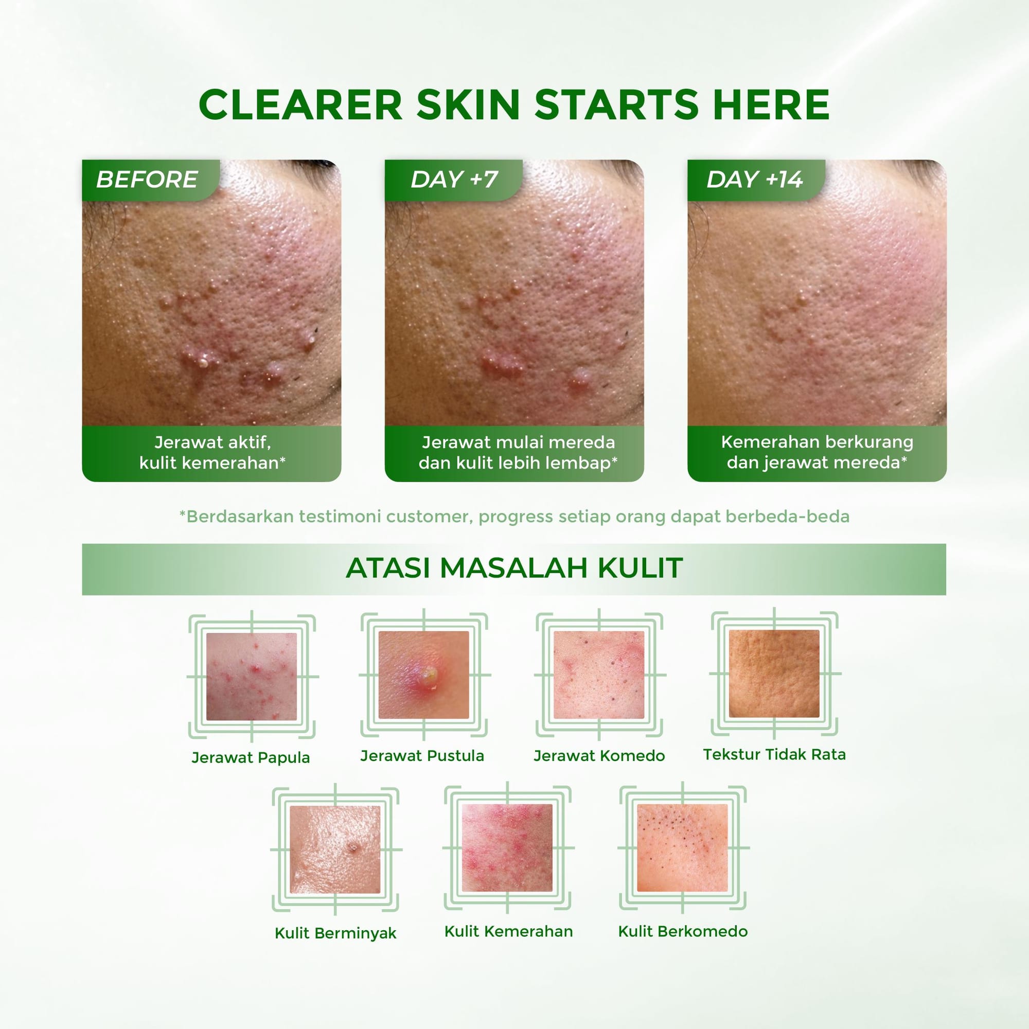 LUMIWHITE - Paket Acne Care (FREE 1 SACHET RNDM+CLOUD PADS+POUCH)