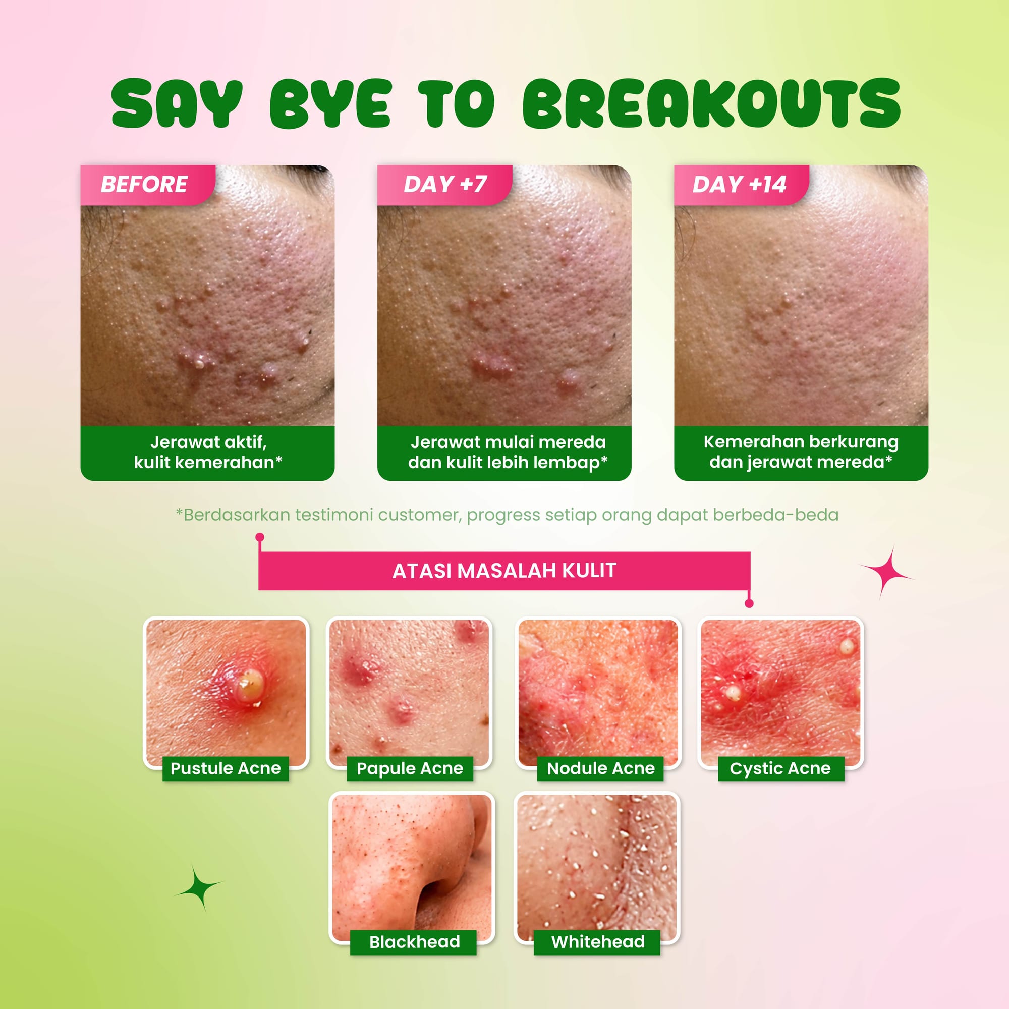  LUMIWHITE - Paket Acne Shield Series (FREE 1 SACHET RNDM+CLOUD PADS+POUCH)